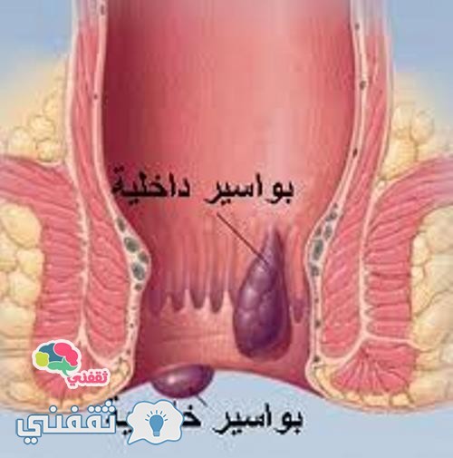 10طرق منزلية لعلاج البواسير فى المنزل ثقفني
