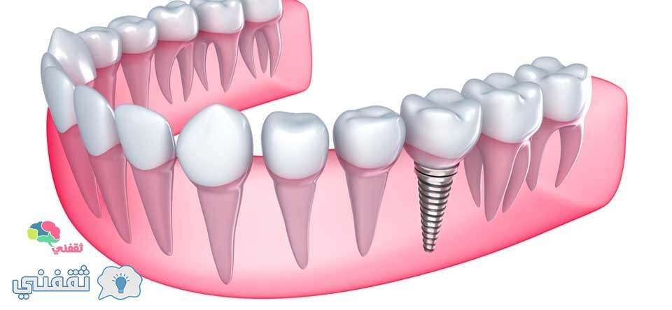 زراعة الاسنان