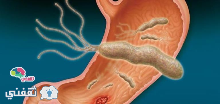 الميكروب الحلزوني أسبابه وأعراضه وعلاجه بالأعشاب