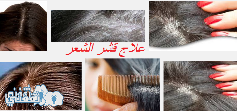 طريقة التخلص من قشرة الشعر