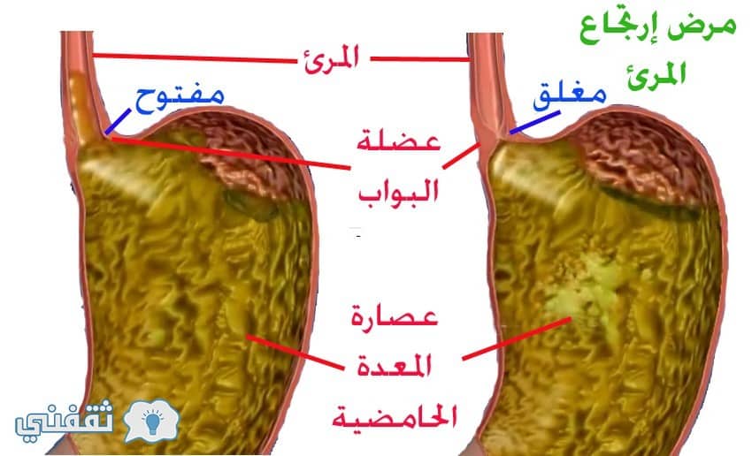 أهم أسباب حرقة المعدة وارتجاع المريء وكيفية علاجهم