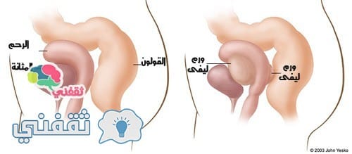 أورام الرحم الليفية