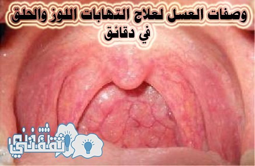 العسل لعلاج إلتهابات اللوز والحلق