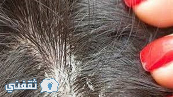 وصفات طبيعية لعلاج وتطهير فروة الرأس من قشر الشعر نهائياً