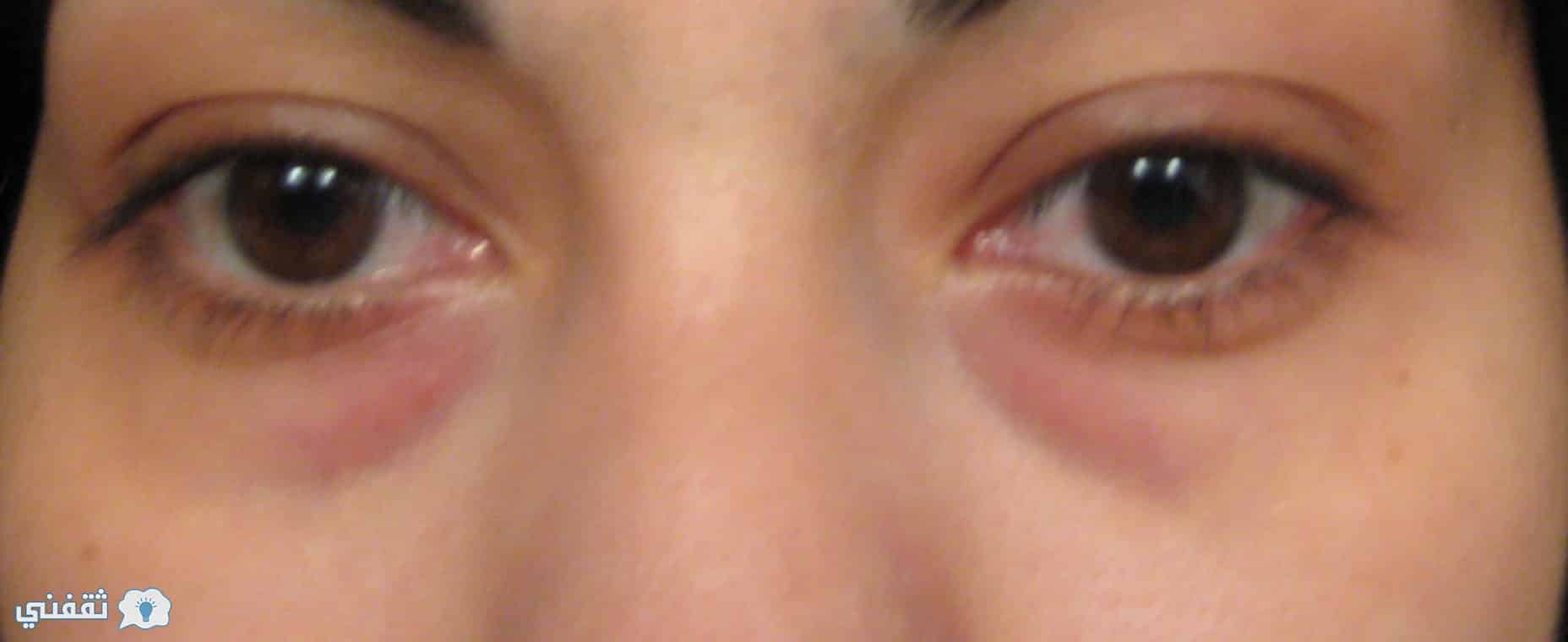 طرق علاج انتفاخ العينين