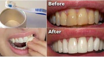 التخلص من ترسبات الاسنان