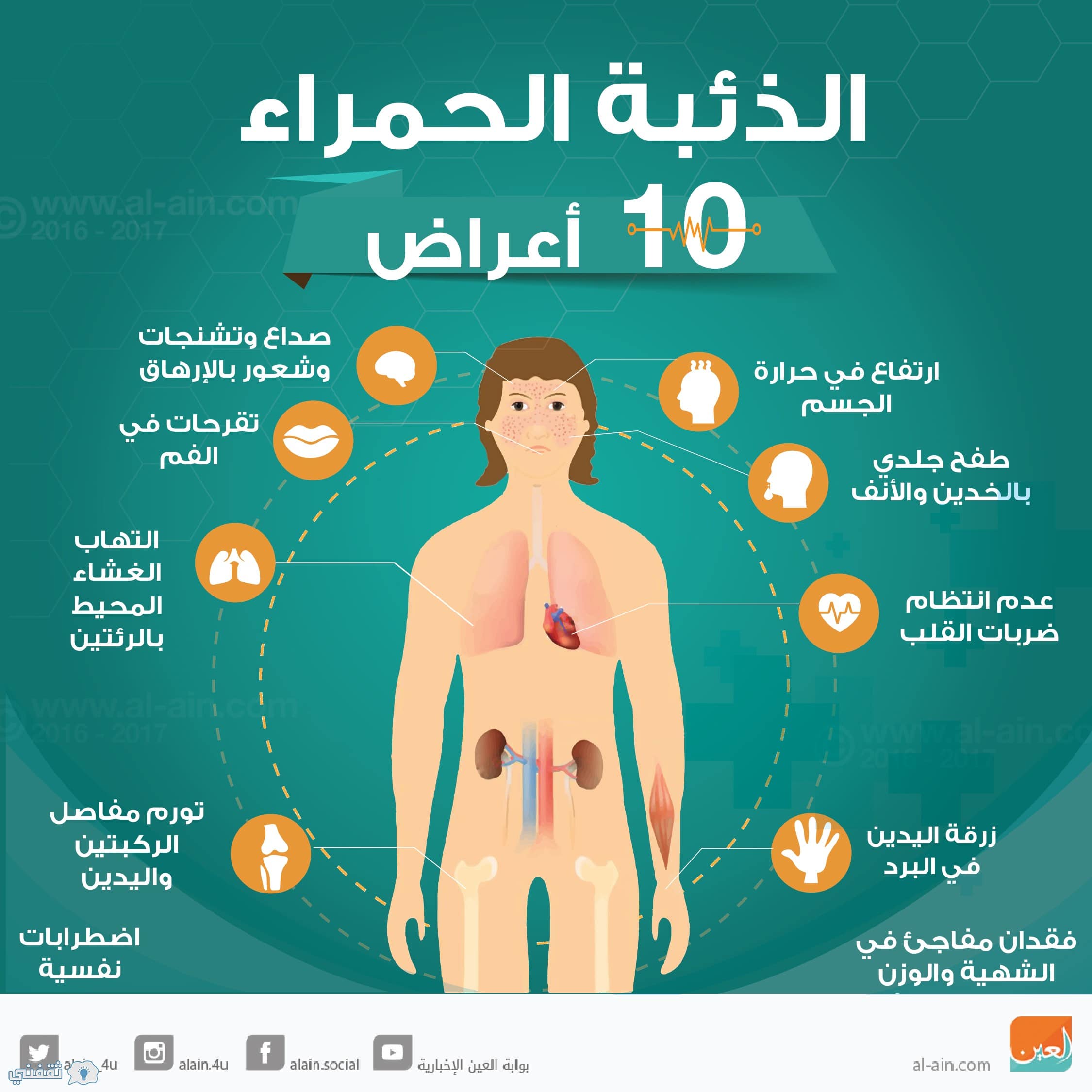 مرض الذئبة الحمراء