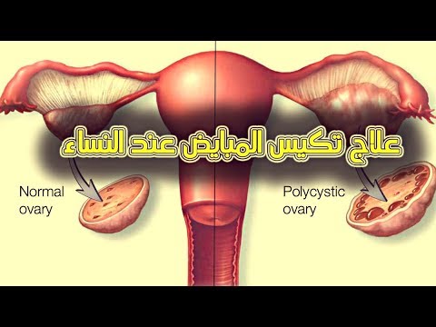 أعراض تكيس المبايض