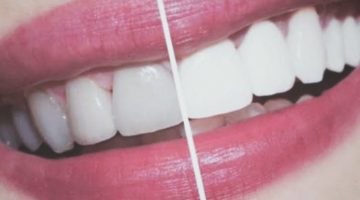 خلطة تبييض الاسنان