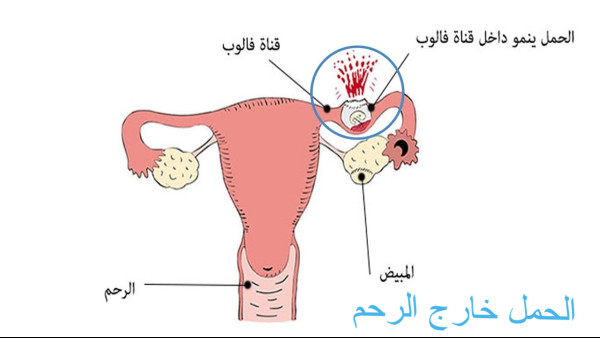 إفرازات الحمل خارج الرحم
