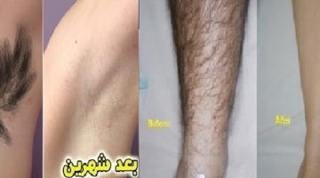 إزالة الشعر ومنع نموه مرة أخرى