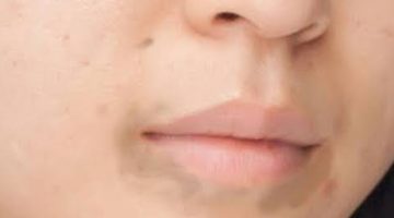 ازالة السواد حول الفم في يوم واحد فقط بطريقتين مختلفتين مختلفتين