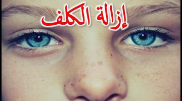 أهم الطرق الطبية والوصفات الطبيعية للتخلص من كلف الوجه