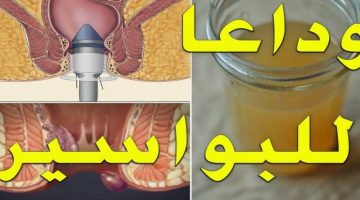 علاج البواسير الداخلية