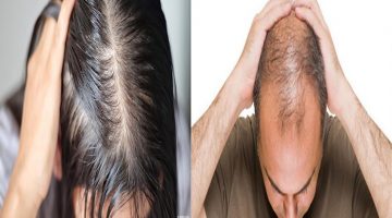 علاج الشعر الخفيف للرجال والنساء