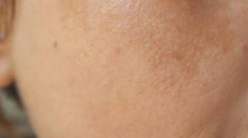 علاج الكلف في الوجه وعلاج البقع السوداء في الوجه وتفتيح الوجه