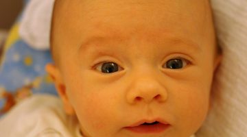 علاج الصفراء عند الأطفال حديثي الولادة