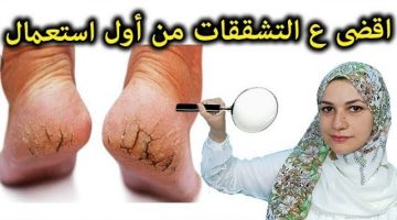 التخلص من تشققات القدم