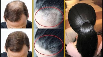 علاج تساقط الشعر والصلع