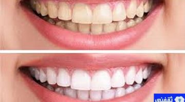 تبييض الأسنان وإزالة الجير طبيعيا