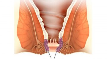 كيفية علاج البواسير