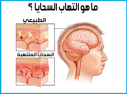 التهاب السحايا ماهو ماهو إلتهاب