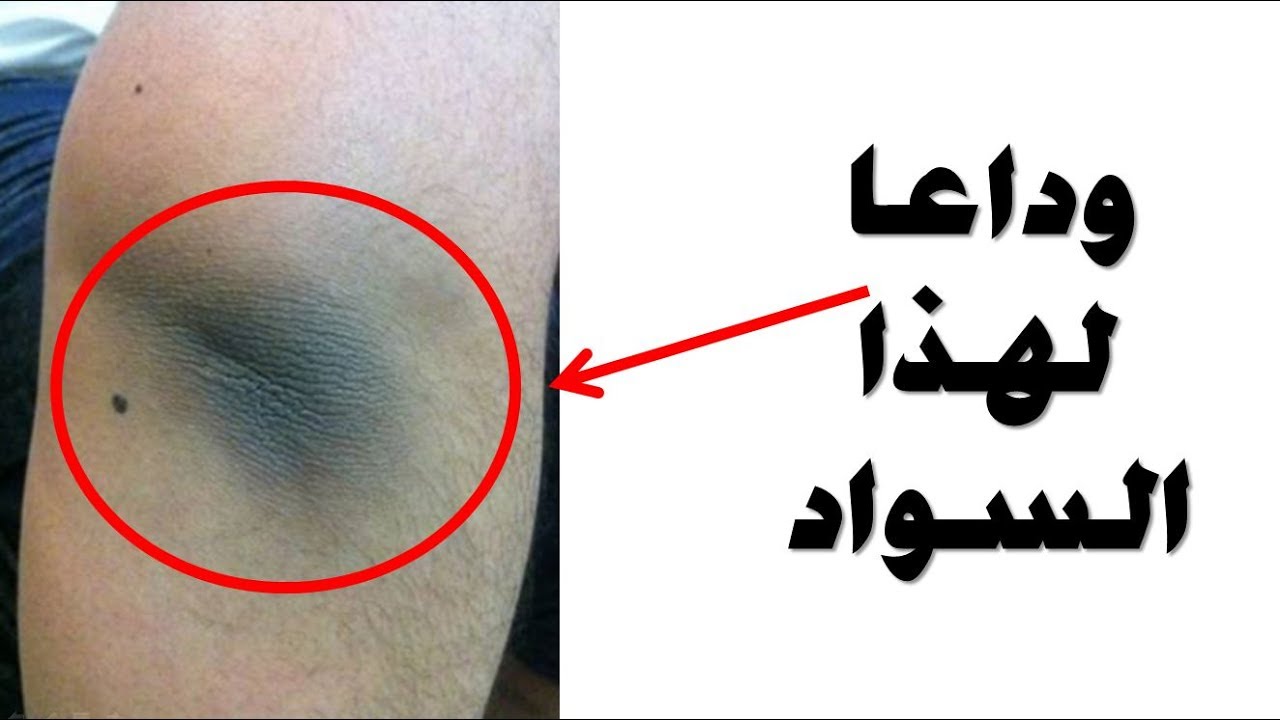 تبييض البشرة