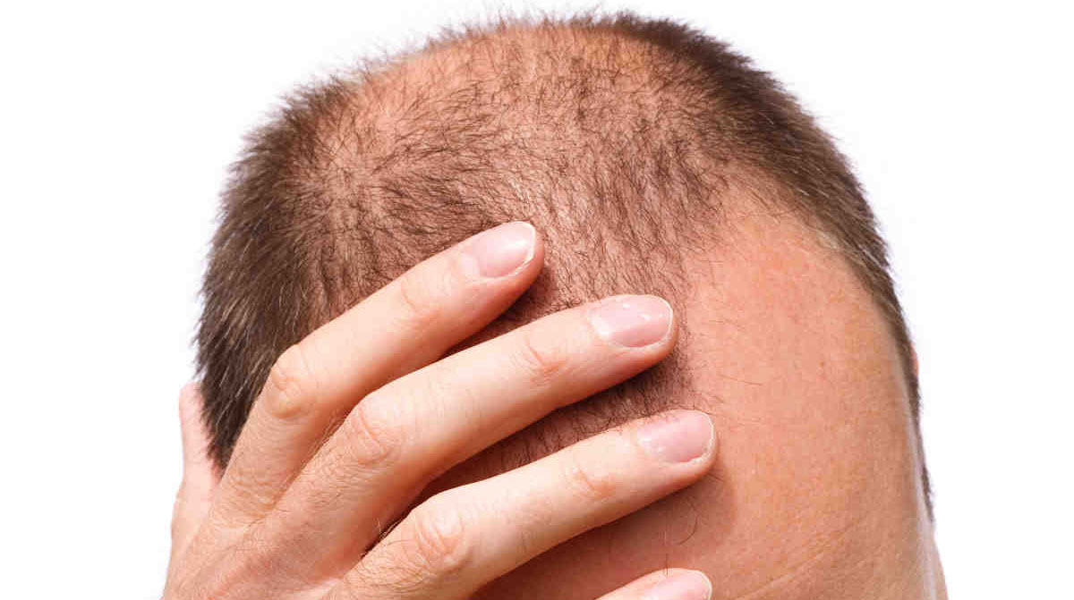 علاج للصلع نهائي