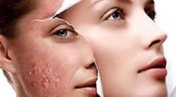 تقشير الوجه وإزالة الجلد الميت من الوجه