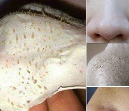 أفضل طريقة لازاله الرؤوس السوداء من الأنف بالبخار ومعجون الأسنان فعاله100 ثقفني