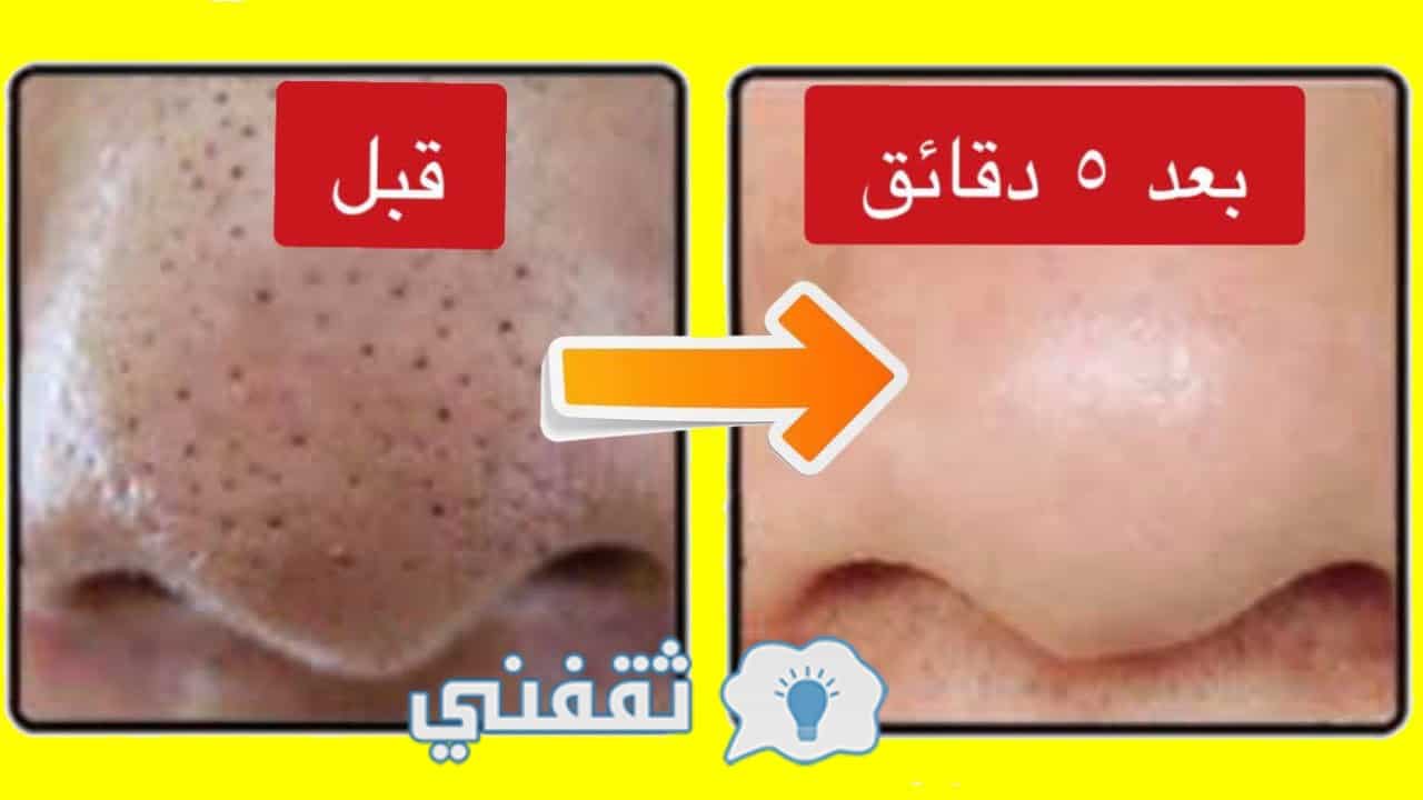 خلال 5 دقائق فقط يمكنك إزالة الرؤوس السوداء نهائيا وبكل سهولة باستخدام هذه الوصفات المذهلة