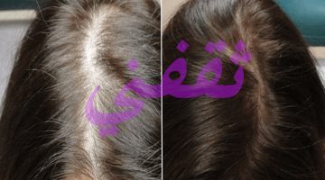 علاج تساقط الشعر الفعال