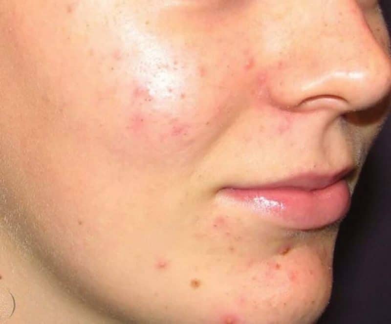 علاج حب الشباب وأسبابه وطرق التخلص منه بوصفات من المنزل ثقفني