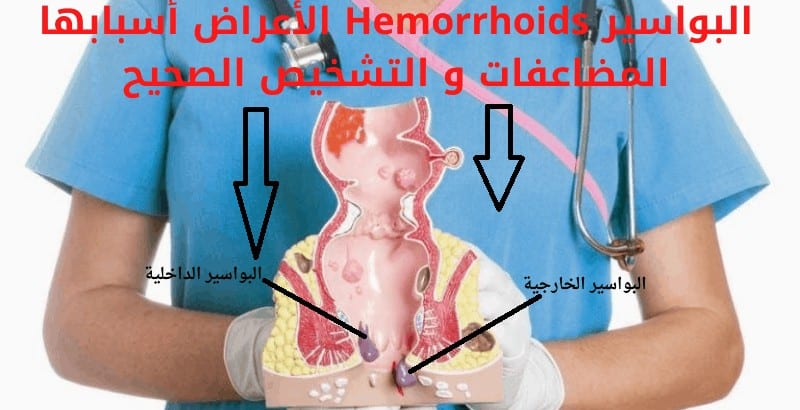 البواسير Hemorrhoids أنواعها الأعراض أسبابها المضاعفات و التشخيص الصحيح ثقفني