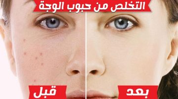 طرق طبيعية للتخلص من حبوب الشباب