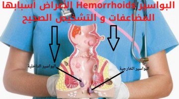 البواسير Hemorrhoids الأعراض أسبابها المضاعفات و التشخيص الصحيح