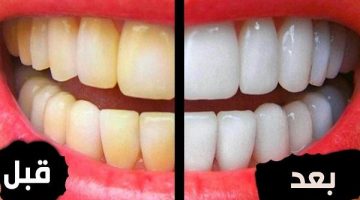 وصفات لتبييض الأسنان
