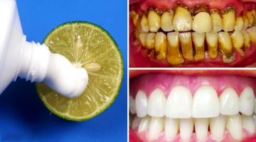 تبييض الأسنان بالليمون فورًا