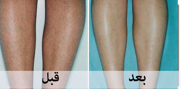 كريم لازالة الشعر
