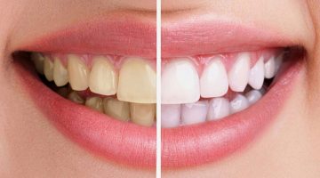 تبييض الأسنان بوصفات طبيعية منزلية