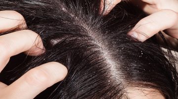 وصفات للتخلص من قشرة الشعر نهائياً