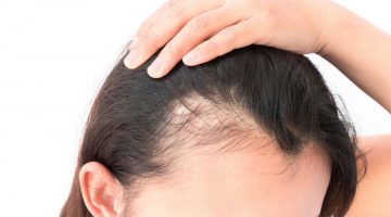 أسباب تساقط الشعر للسيدات و طرق طبيعيه لعلاج