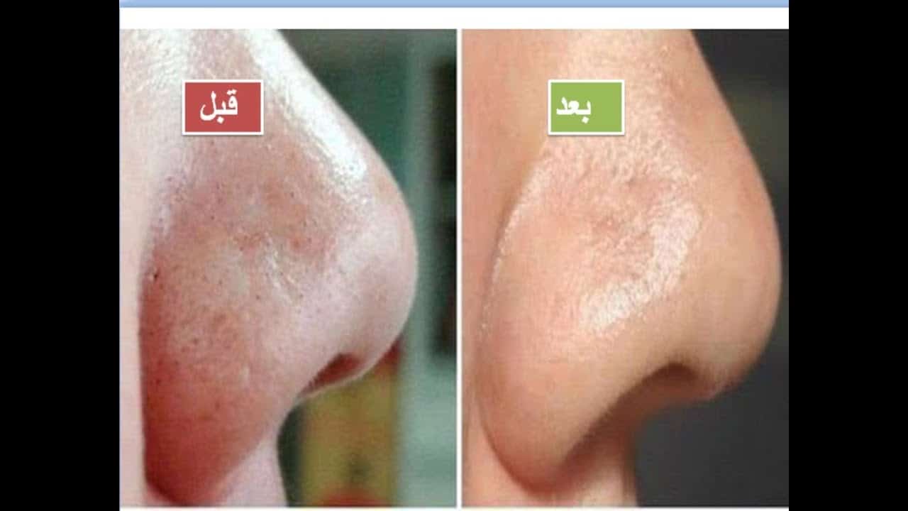 وصفات لأزاله الرؤوس السوداء من الأنف بطريقة أمنة وسهلة وغير مكلف
