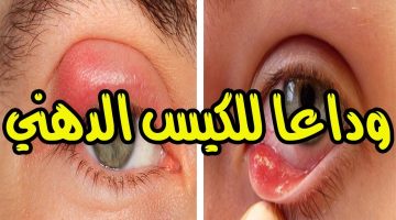 طريقة التخلص من الكيس الدهني في جفن العين وعلاجه بالطرق الطبيعية