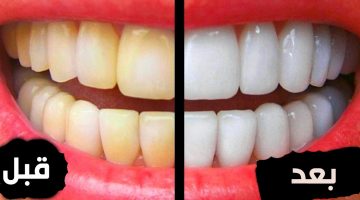 كيفيه التخلص من الأسنان الصفراء