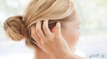 وصفات طبيعية لعلاج قشرة الشعر المزعجة والتخلص منها من اول استخدام