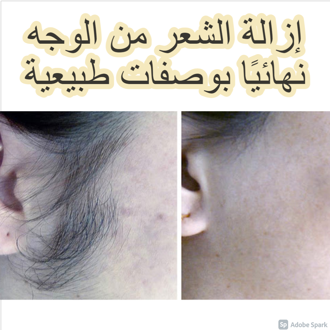 إزالة الشعر من الوجه نهائيًا