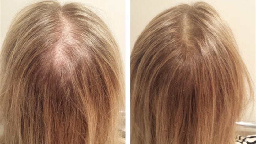 خلطات لتكثيف الشعر الخفيف ، تم اختبارها في 7 أيام فقط ، مع بعض النصائح