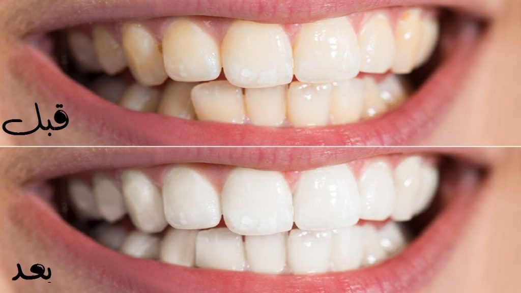 طريقة سحرية لتبييض الاسنان في يوم واحد بطريقة مضمونة وسريعة