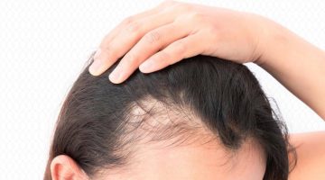 وصفات لنمو شعر مقدمة الرأس والفراغات